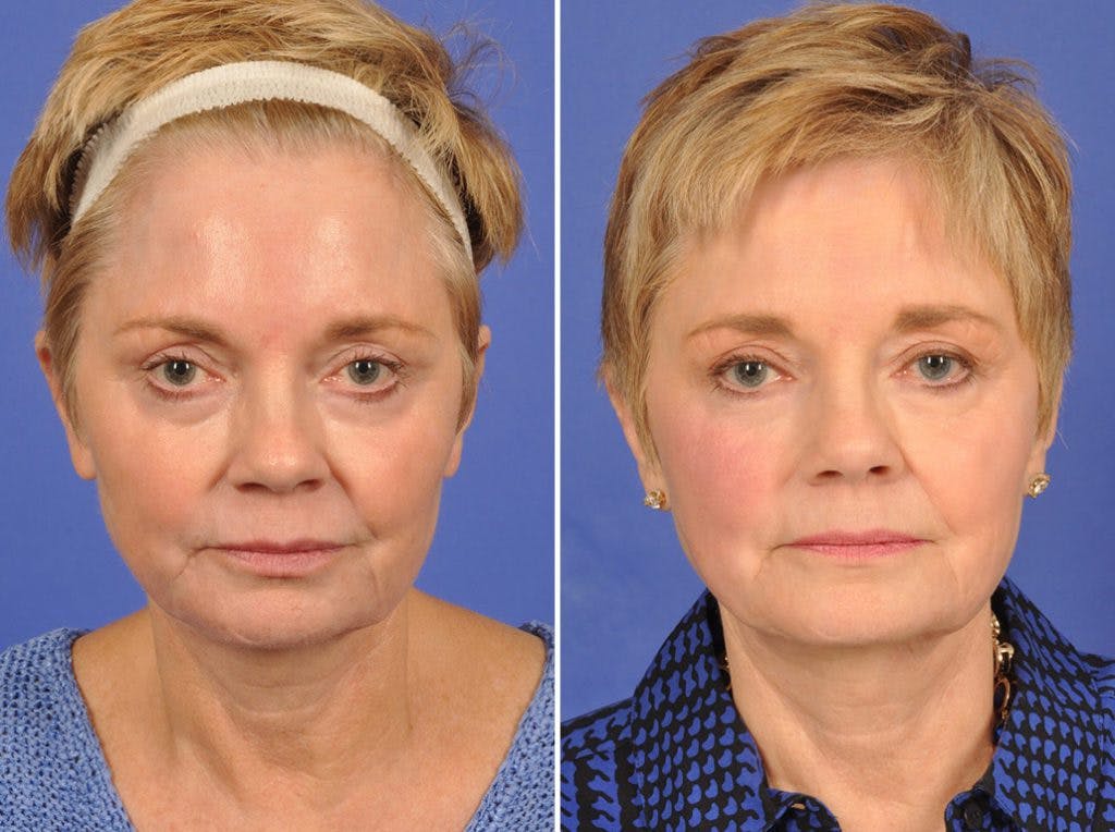 Facelift Before & After Gallery - Patient 112082 - Image 1