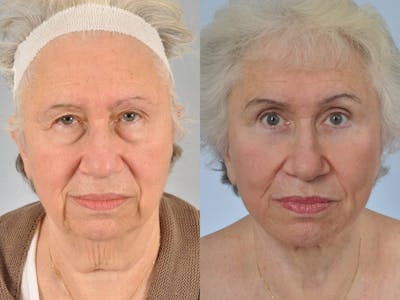 Facelift Before & After Gallery - Patient 204255 - Image 2