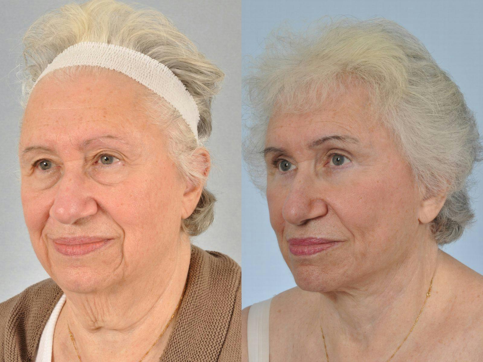 Facelift Before & After Gallery - Patient 204255 - Image 4