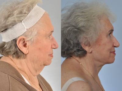 Facelift Before & After Gallery - Patient 204255 - Image 5