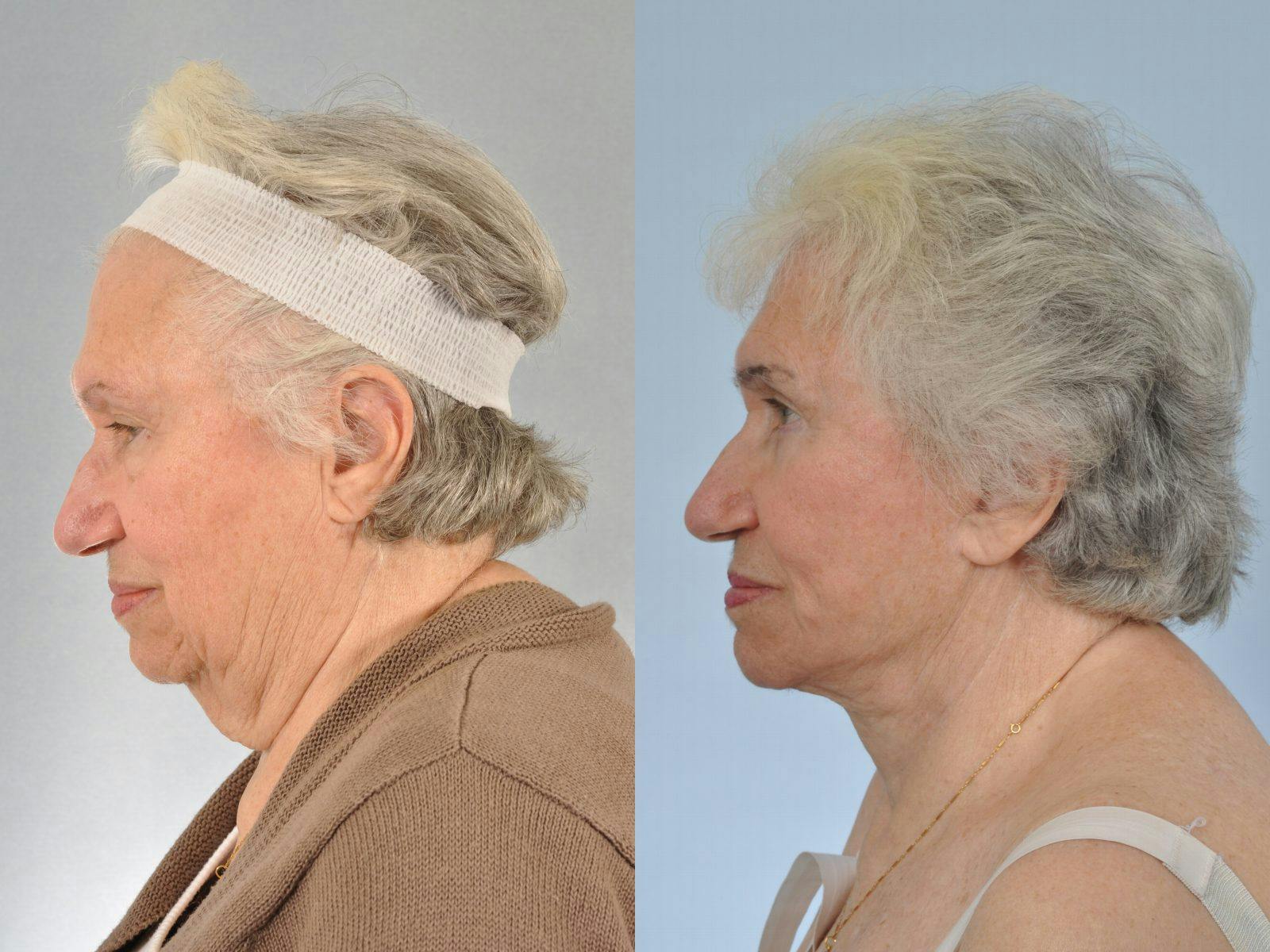 Facelift Before & After Gallery - Patient 204255 - Image 6