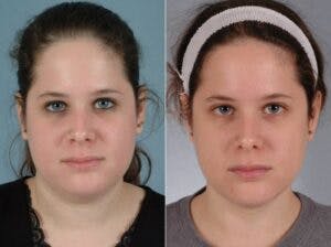 Facelift Before & After Gallery - Patient 331874 - Image 1