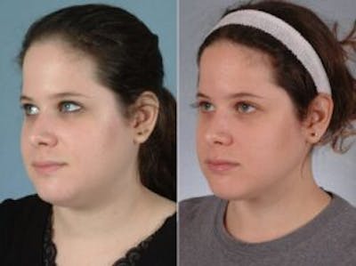 Facelift Before & After Gallery - Patient 331874 - Image 2
