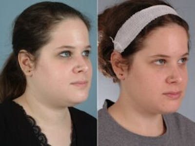 Facelift Before & After Gallery - Patient 331874 - Image 3