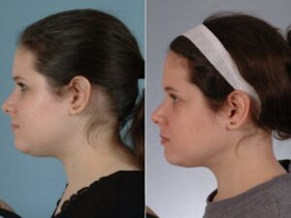 Facelift Before & After Gallery - Patient 331874 - Image 4