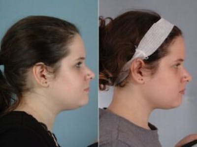 Facelift Before & After Gallery - Patient 331874 - Image 5