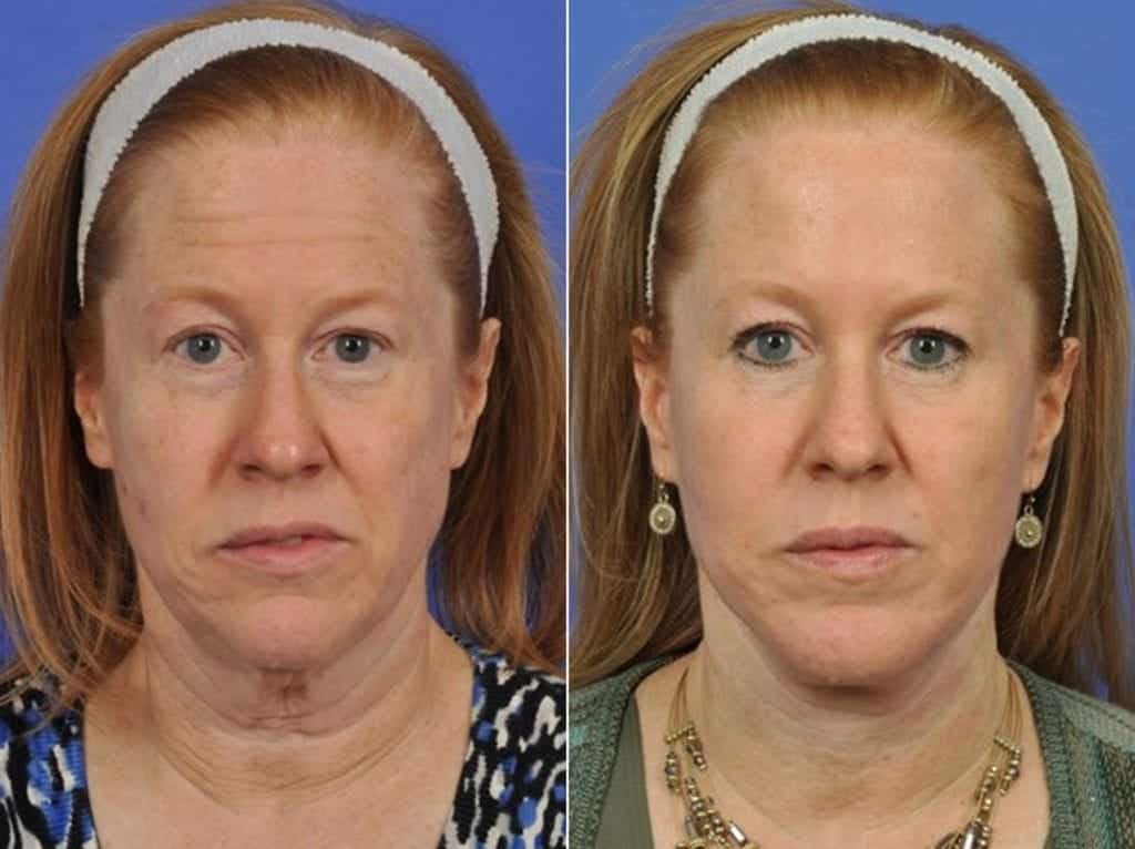 Facelift Before & After Gallery - Patient 201292 - Image 1