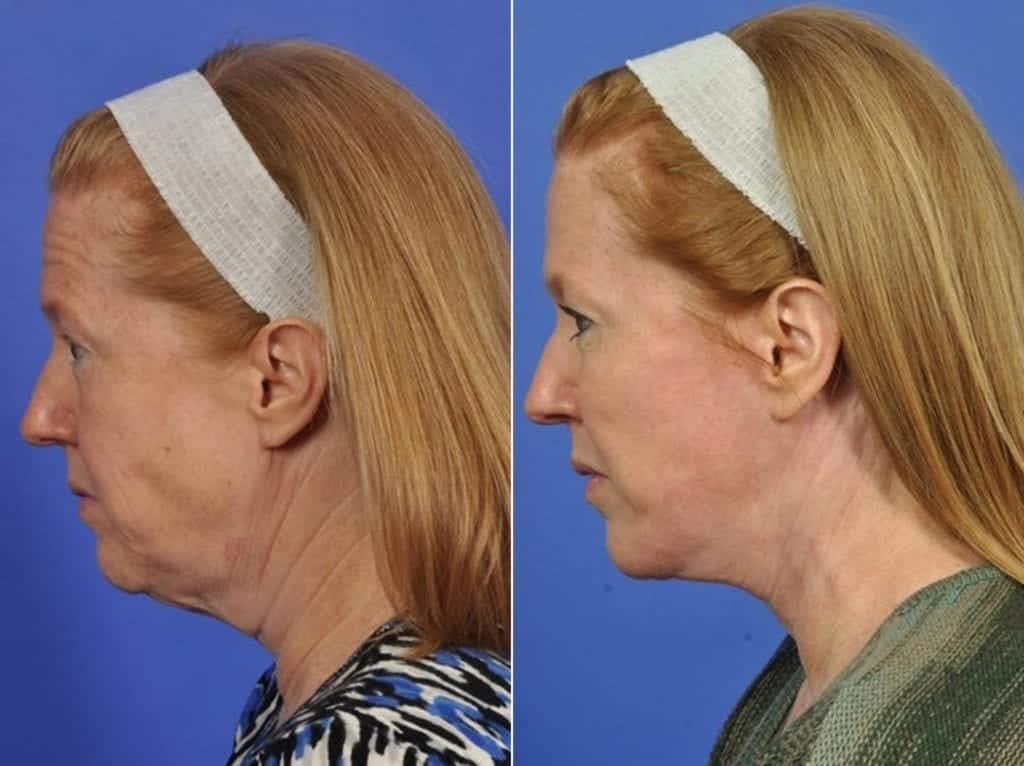 Facelift Before & After Gallery - Patient 201292 - Image 2
