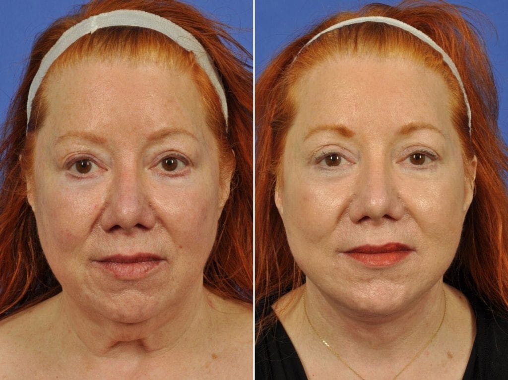 Facelift Before & After Gallery - Patient 308678 - Image 1