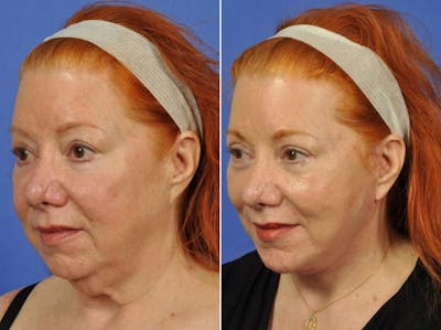 Facelift Before & After Gallery - Patient 308678 - Image 2