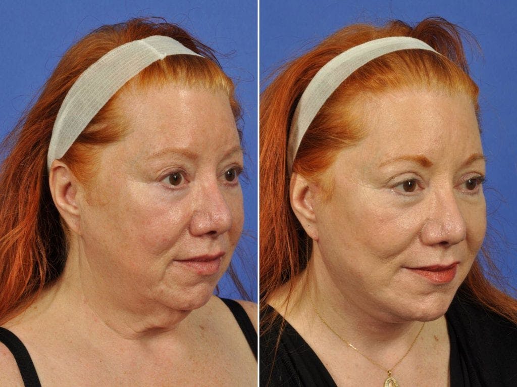 Facelift Before & After Gallery - Patient 308678 - Image 3