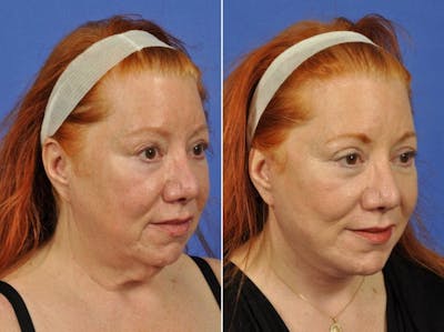 Facelift Before & After Gallery - Patient 308678 - Image 3