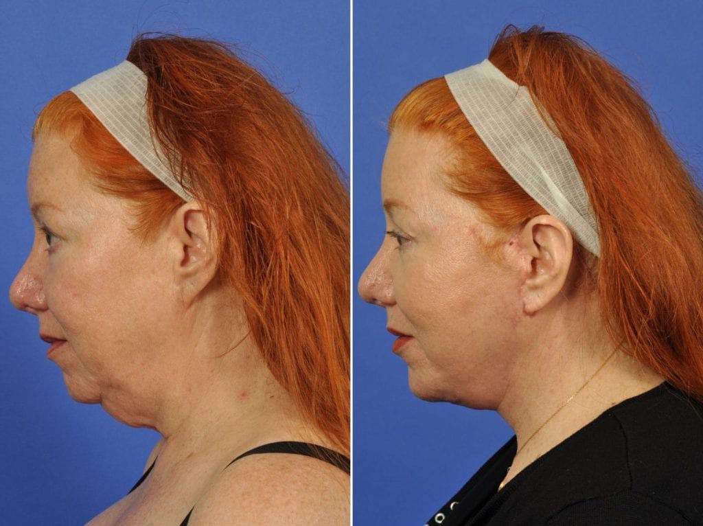 Facelift Before & After Gallery - Patient 308678 - Image 4