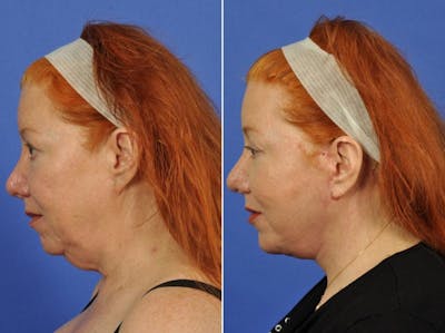 Facelift Before & After Gallery - Patient 308678 - Image 4