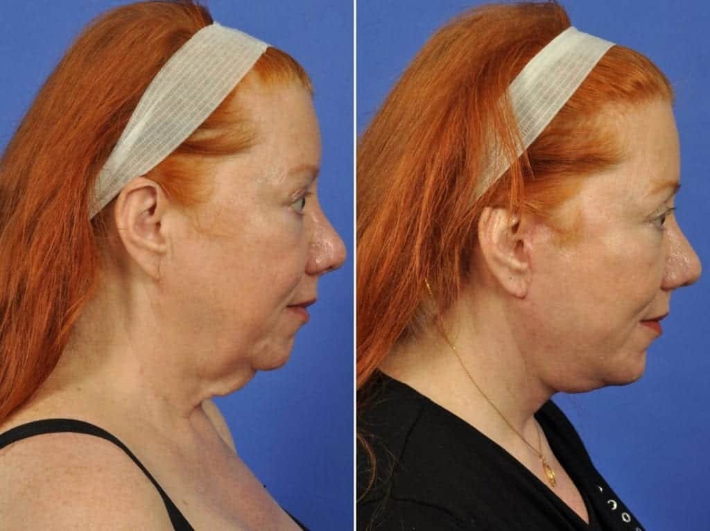 Facelift Before & After Gallery - Patient 308678 - Image 5