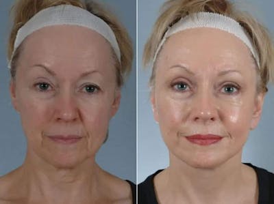 Facelift Before & After Gallery - Patient 184852 - Image 1