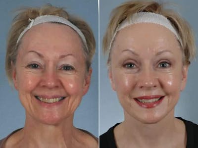 Facelift Before & After Gallery - Patient 184852 - Image 2
