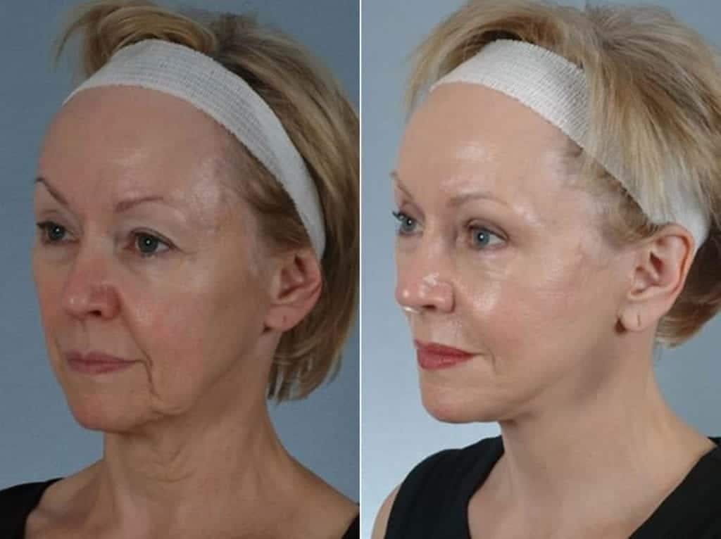 Facelift Before & After Gallery - Patient 184852 - Image 3