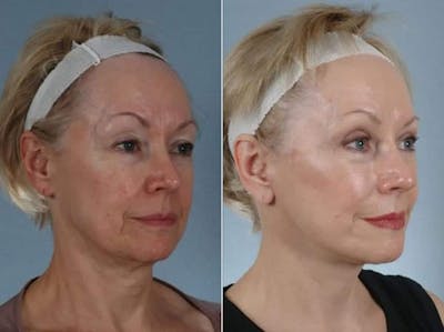 Facelift Before & After Gallery - Patient 184852 - Image 4