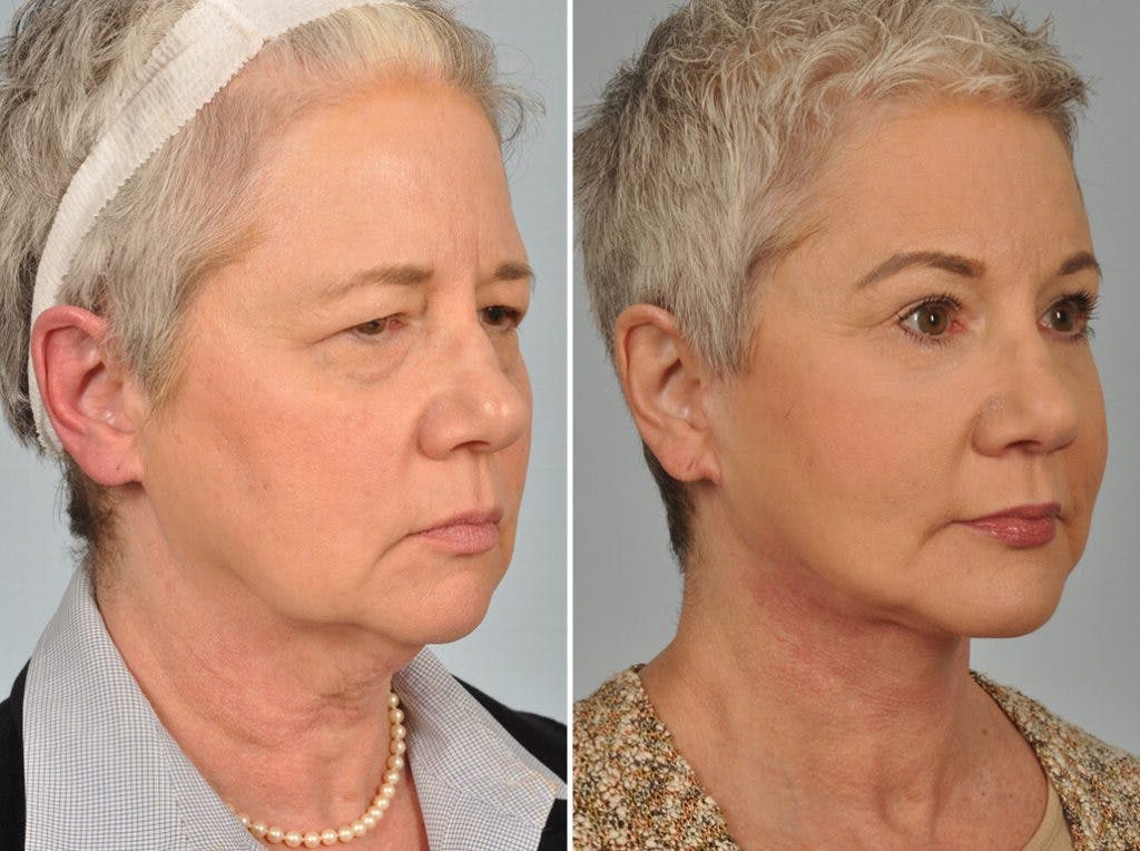 Facelift Before & After Gallery - Patient 343444 - Image 3