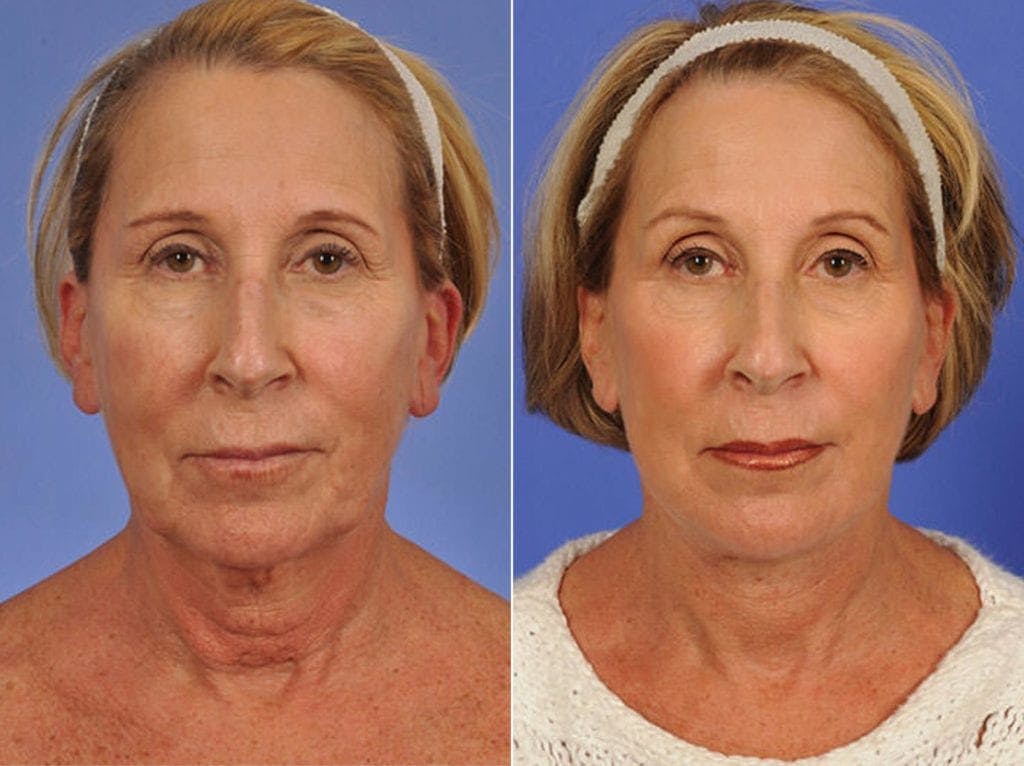 Facelift Before & After Gallery - Patient 221239 - Image 1