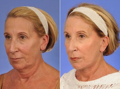 Facelift Before & After Gallery - Patient 221239 - Image 2