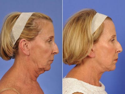 Facelift Before & After Gallery - Patient 221239 - Image 3