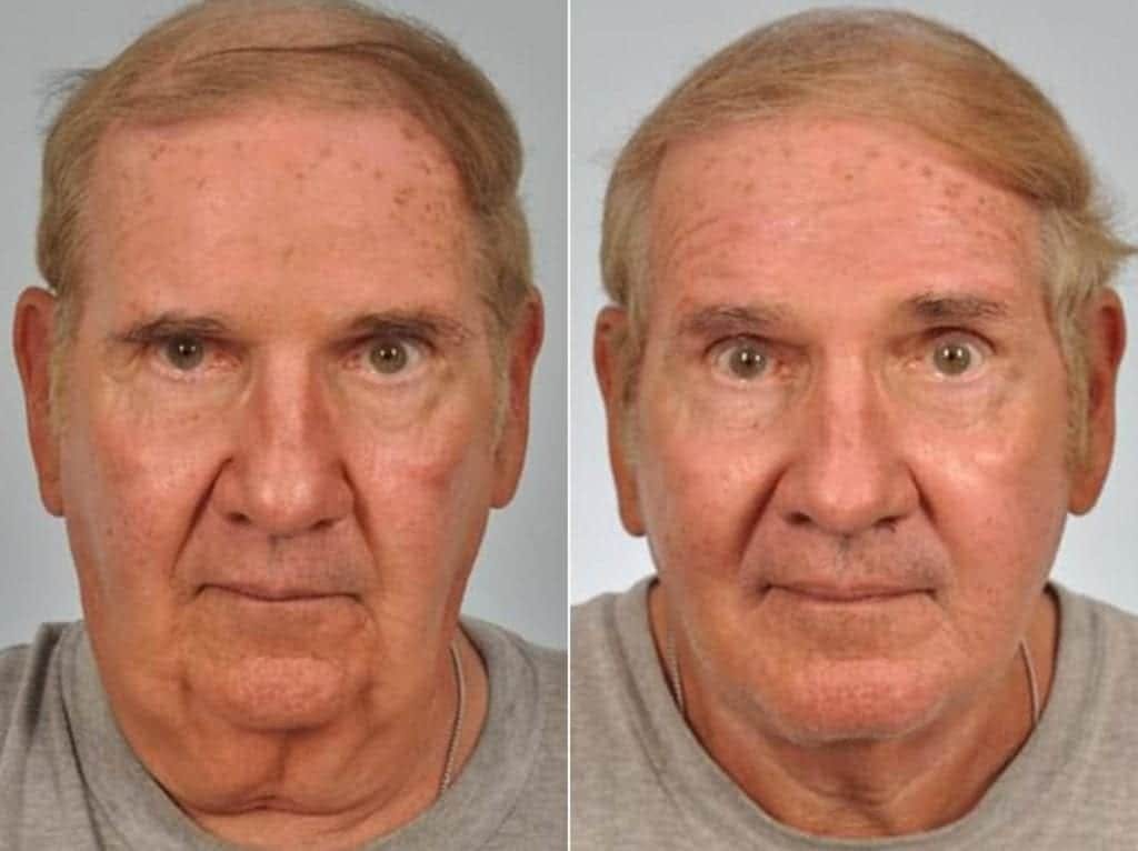Facelift Before & After Gallery - Patient 264298 - Image 1