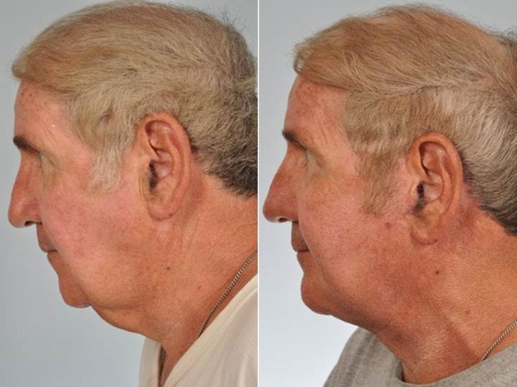 Facelift Before & After Gallery - Patient 264298 - Image 2