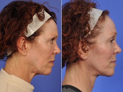 Facelift Before & After Gallery - Patient 710772 - Image 2