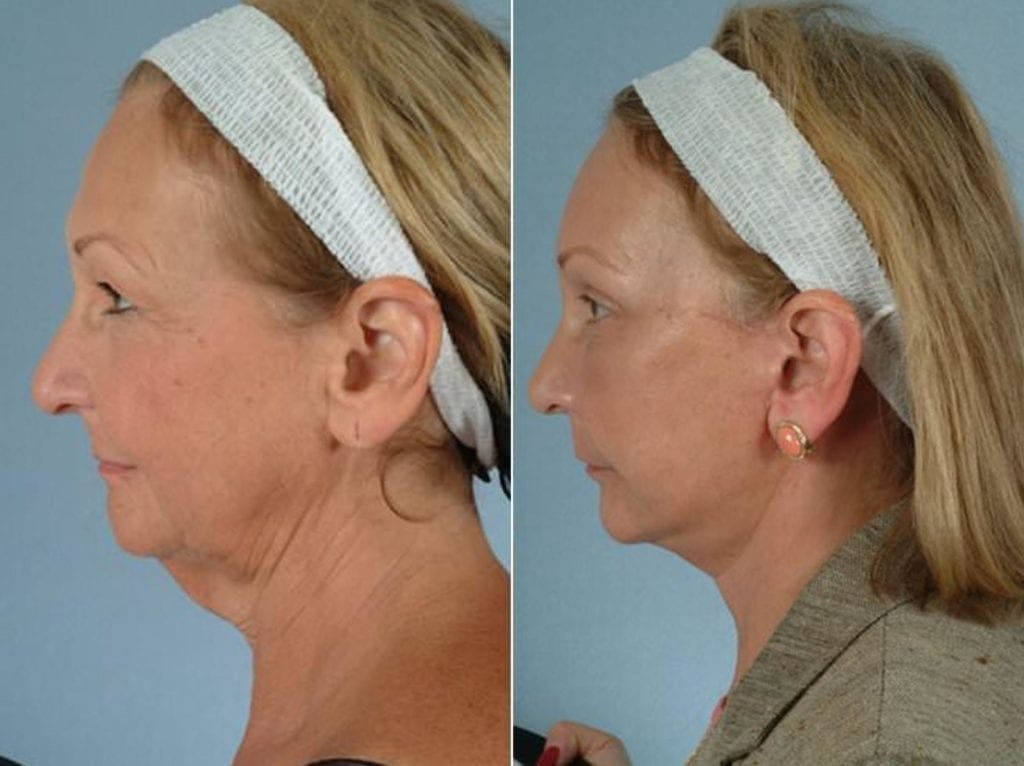Facelift Before & After Gallery - Patient 137797 - Image 1