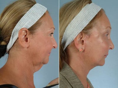 Facelift Before & After Gallery - Patient 137797 - Image 2