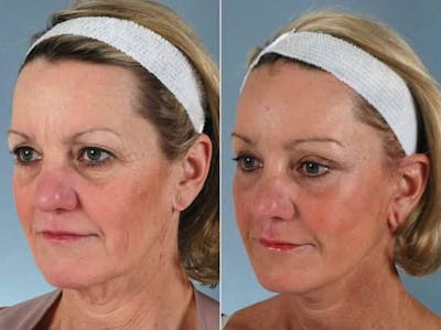 Facelift Before & After Gallery - Patient 379639 - Image 2
