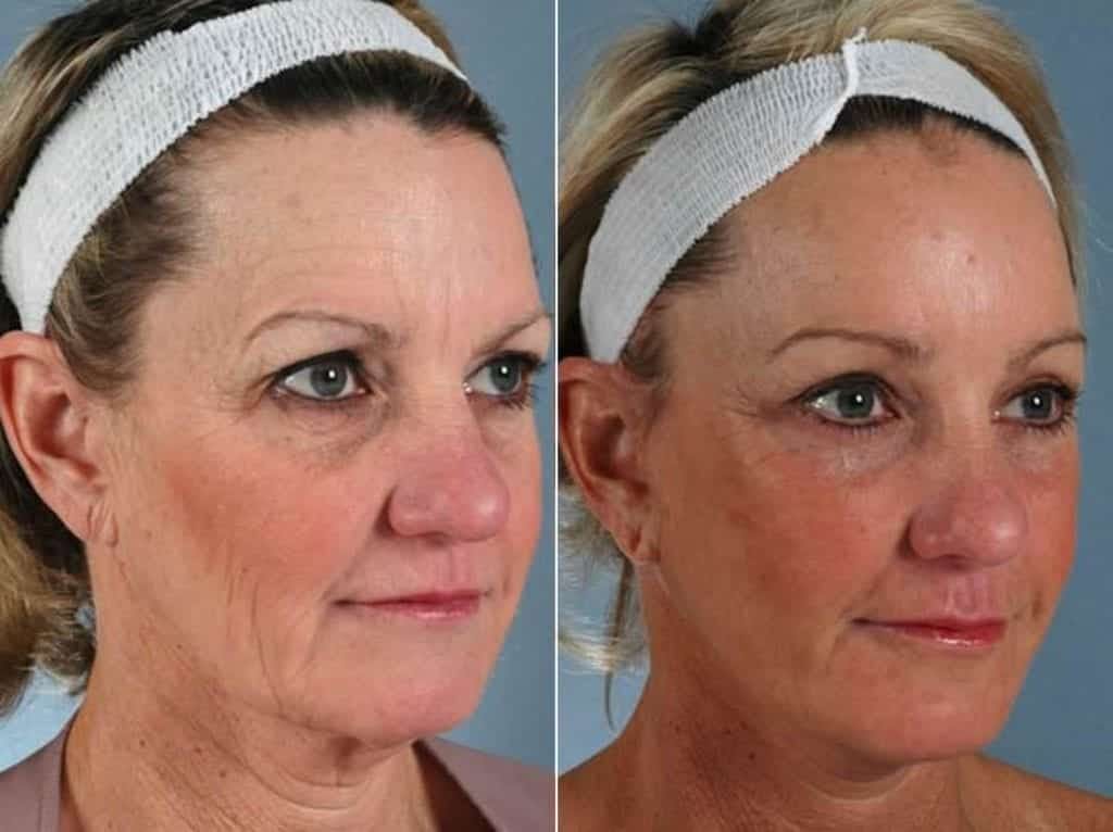 Facelift Before & After Gallery - Patient 379639 - Image 3