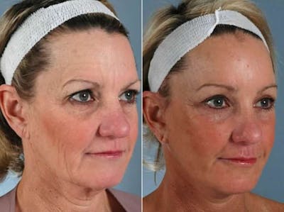 Facelift Before & After Gallery - Patient 379639 - Image 3