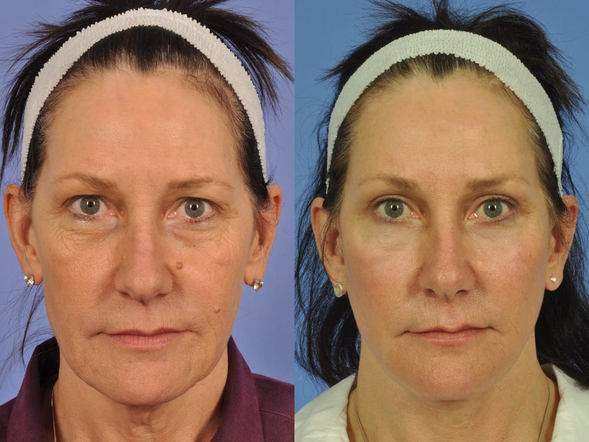 Facelift Before & After Gallery - Patient 328161 - Image 1