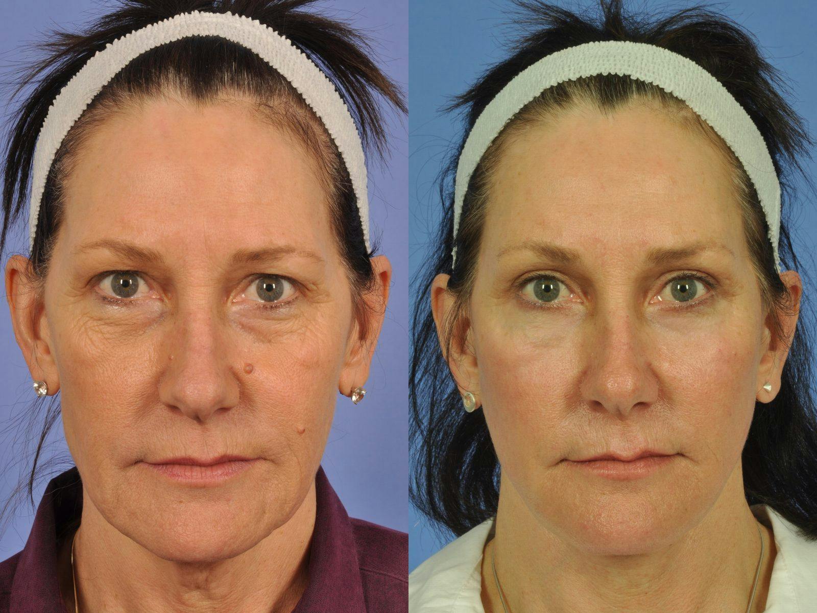 Facelift Before & After Gallery - Patient 328161 - Image 1
