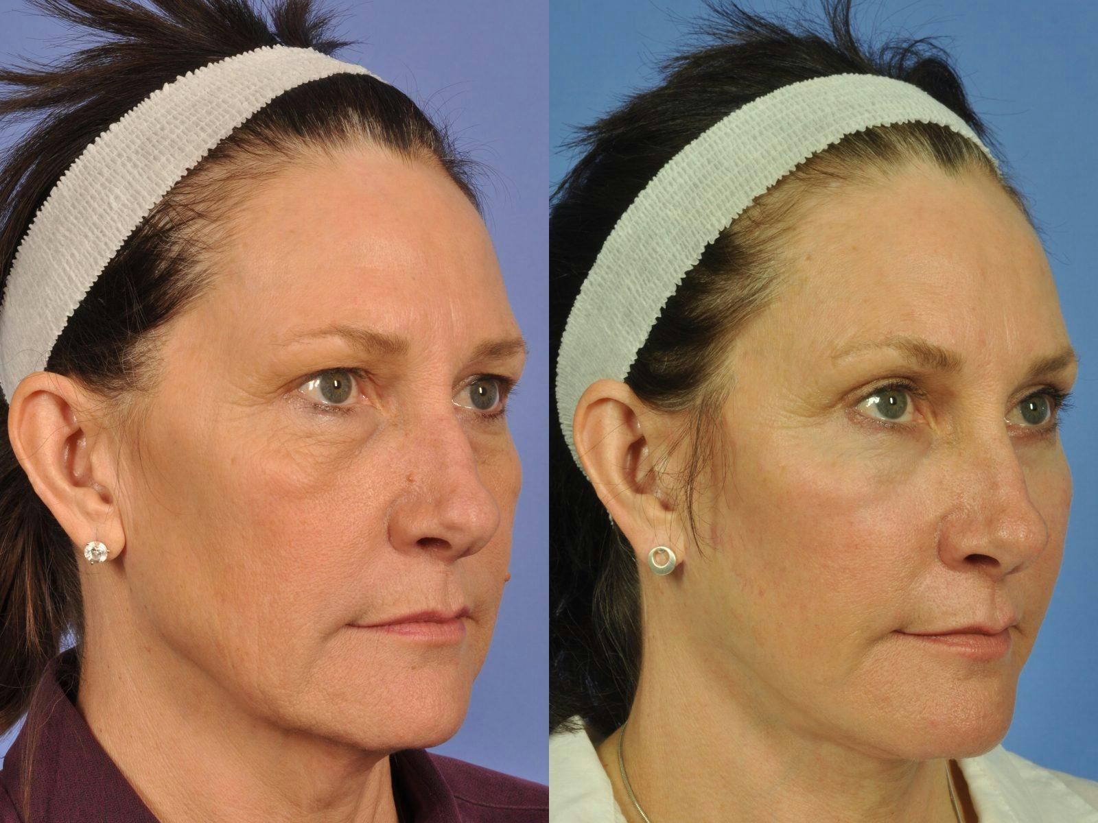 Facelift Before & After Gallery - Patient 328161 - Image 2
