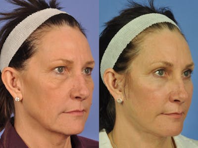 Facelift Before & After Gallery - Patient 328161 - Image 2