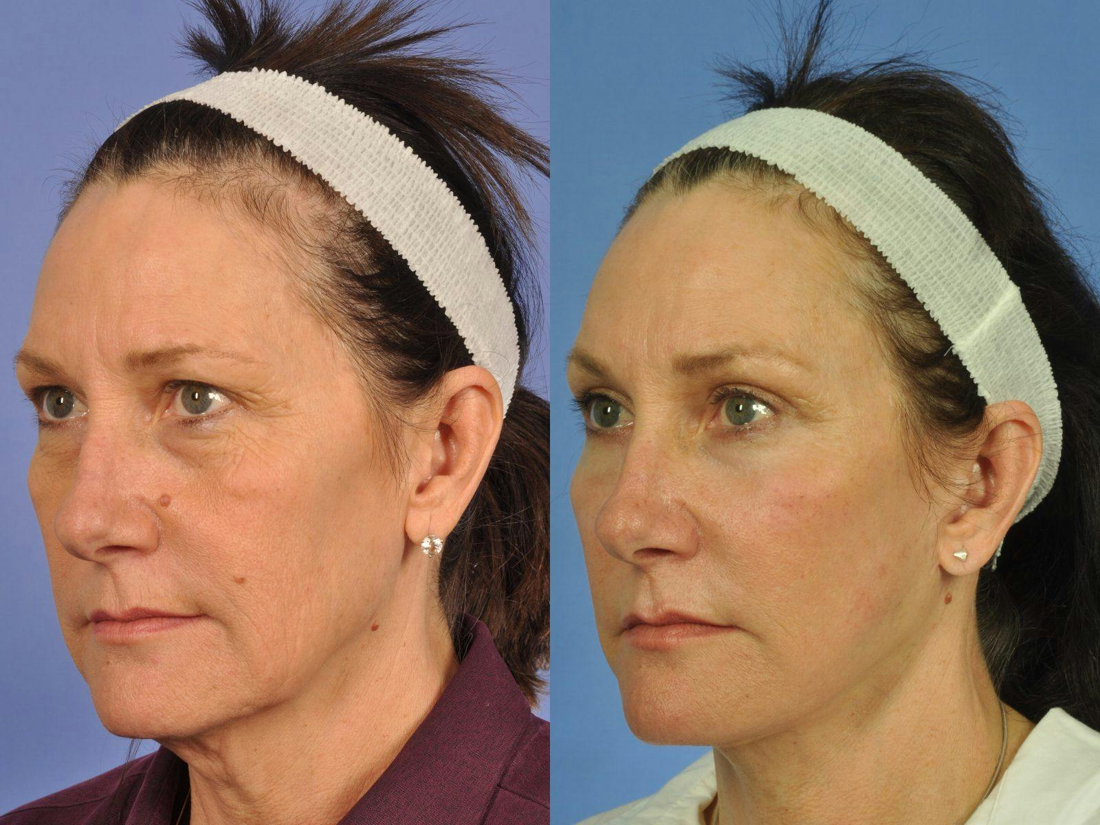 Facelift Before & After Gallery - Patient 328161 - Image 3