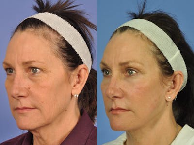 Facelift Before & After Gallery - Patient 328161 - Image 3