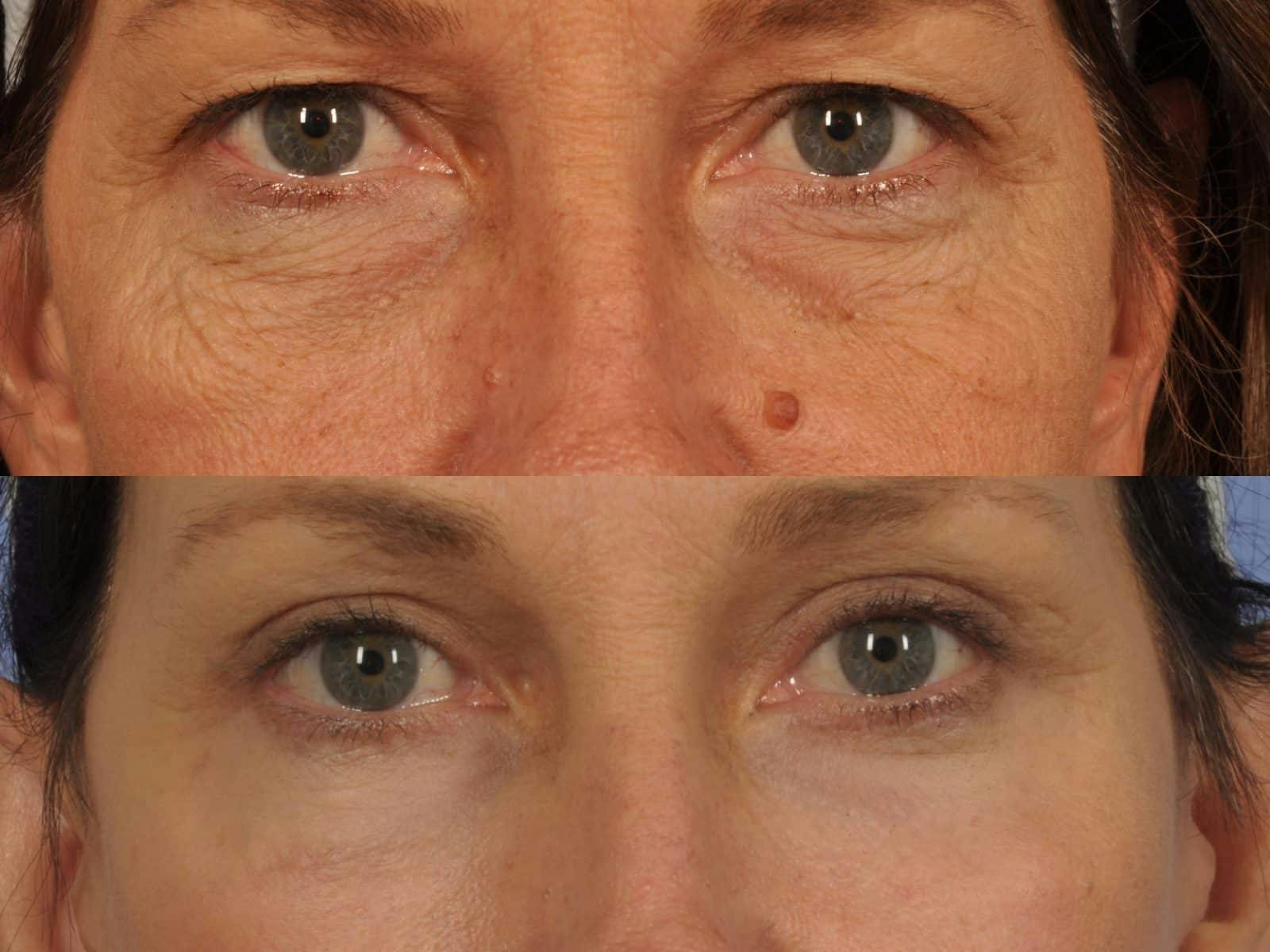Facelift Before & After Gallery - Patient 328161 - Image 4