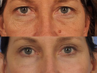 Facelift Before & After Gallery - Patient 328161 - Image 4