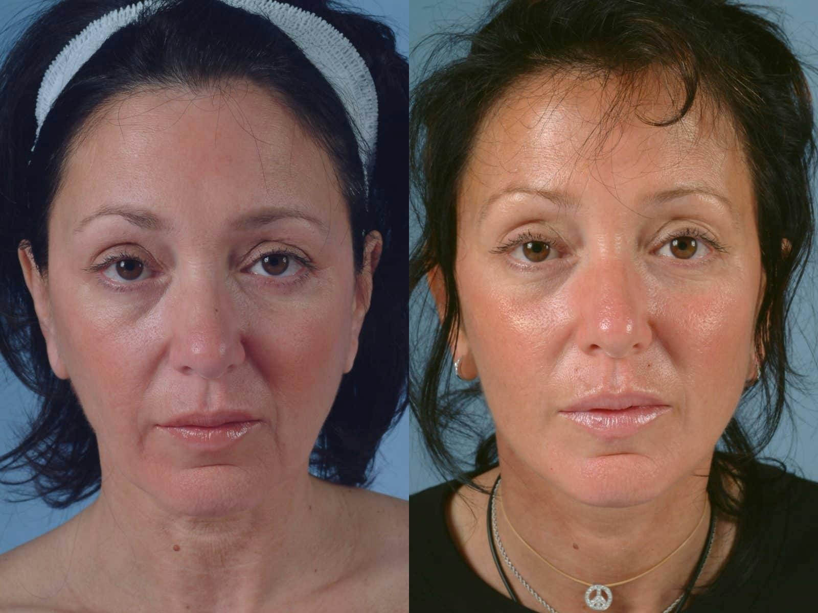 Facelift Before & After Gallery - Patient 423091 - Image 1