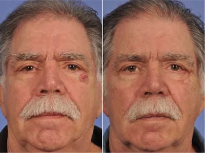 Facial Reconstruction Before & After Gallery - Patient 263366 - Image 1