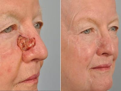 Facial Reconstruction Before & After Gallery - Patient 140870 - Image 1