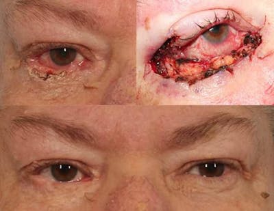 Facial Reconstruction Before & After Gallery - Patient 409005 - Image 1