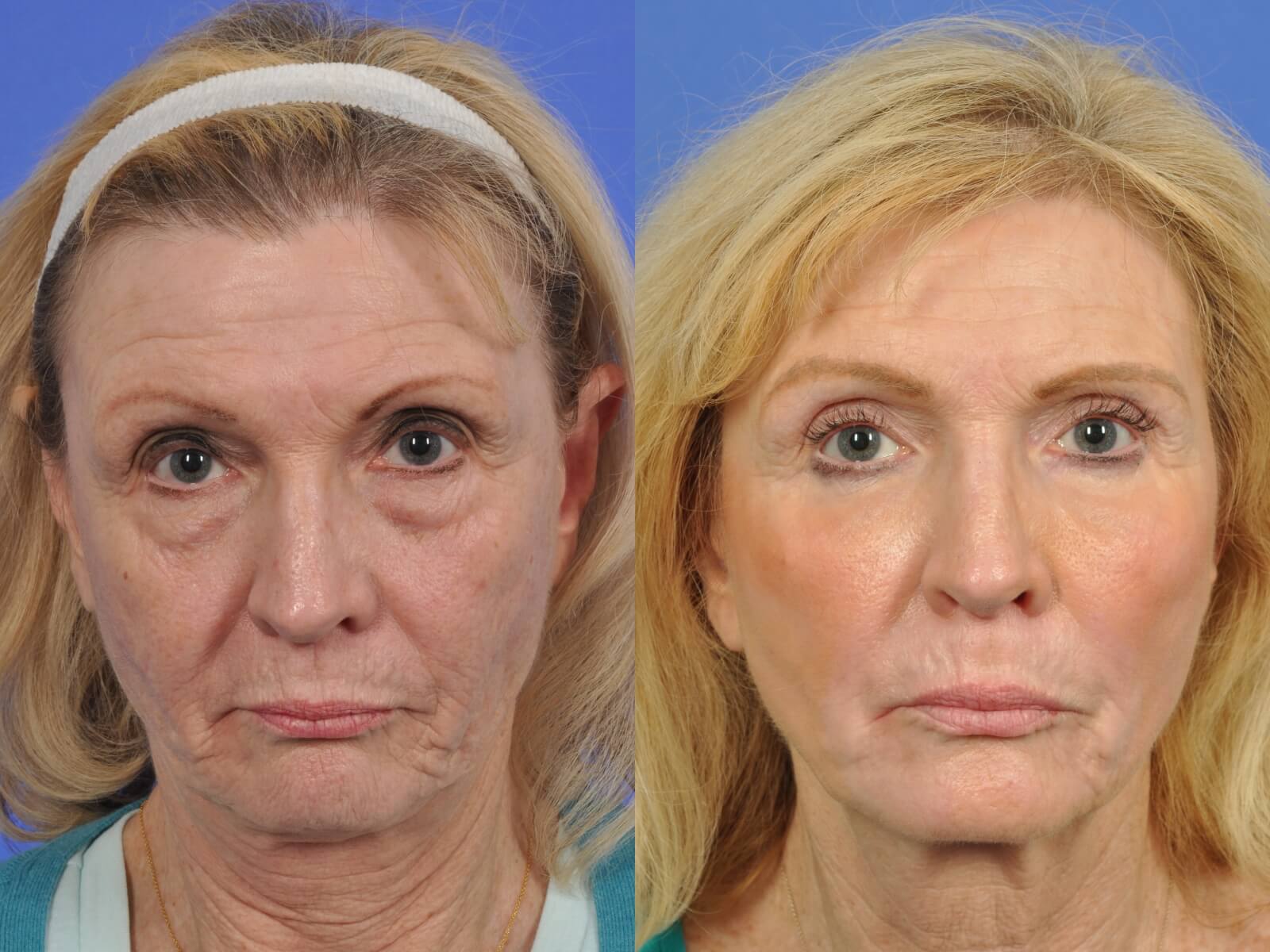 Laser Skin Resurfacing Before After Photos W Cosmetic Surgery