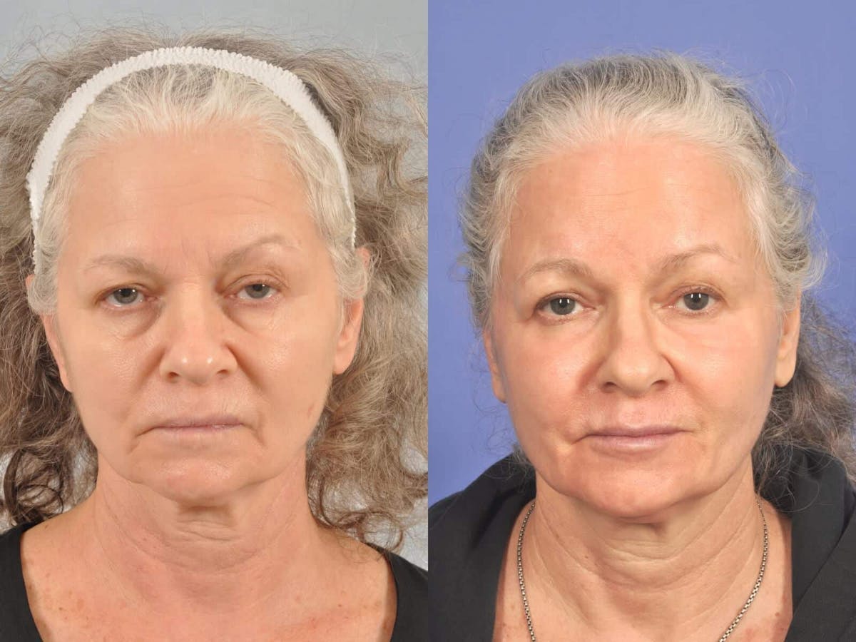 Laser Skin Resurfacing Before & After Gallery - Patient 132191 - Image 1