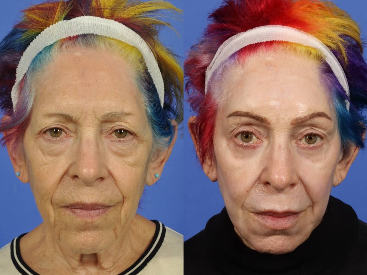 Laser Skin Resurfacing Before & After Gallery - Patient 230027 - Image 1